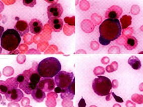 骨髓增生异常综合征患者G-CSF和GM-CSF+标准治疗的证据