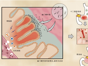 质子泵抑制剂与慢性肾病风险增加相关