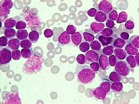 哪些因素促使成人急淋患者的生存期得到改善？