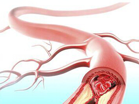 UGI事件风险患者长期服用阿司匹林和奥美拉唑复方制剂是否安全?