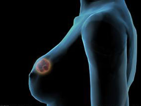 来曲唑可安全地与辅助性乳腺放疗同步给予