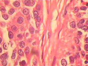 标准治疗添加贝伐单抗可显著改善恶性胸膜间皮瘤总生存期