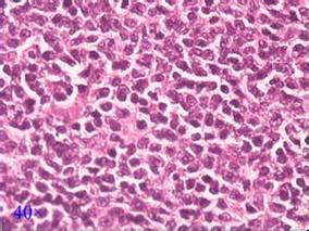 免疫化疗后放射免疫巩固对复发性滤泡性淋巴瘤患者安全有效