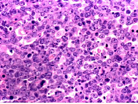 来那度胺联合R-ESHAP治疗复发或难治性DLBCL可行