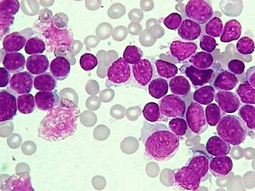 有不利遗传突变的AML高患者也可从高剂量柔红霉素中获益