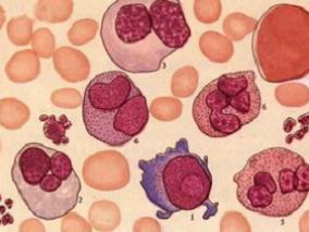 ESA难治低风险非5q缺失MDS患者：LEN+EPO还是LEN？