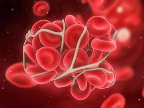 欧洲白血病网响应类别能可靠地预测接受TKIs治疗的CML患者的结局