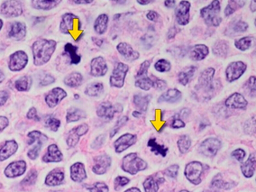 符合移植条件的套细胞淋巴瘤患者：RB/RC诱导方案安全有效