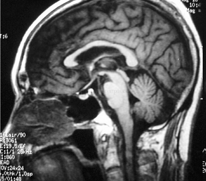 病例34 帕金森、脑卒中和体位性低血压