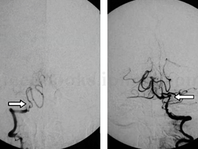 男55岁 因呕吐2天 意识障碍4小时 急性不完全性肠梗阻入院