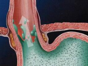 确诊食管癌后服用他汀可显著改善生存率