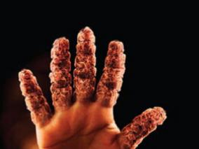 急性痛风患者口服泼尼松龙镇痛效果与吲哚美辛相似