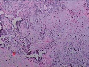 男16岁，因复视、左眼眼球运动障碍10个月入院