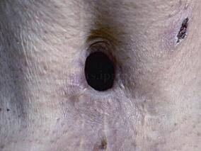 男63岁，因吞咽不适感1年多伴声嘶2个月入院