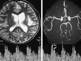 女，14岁，突发右侧肢体偏瘫1年