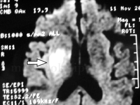 女65岁，左利手，左侧肢体无力5h