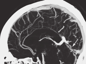 女33岁,四肢麻木无力、言语不清2个月