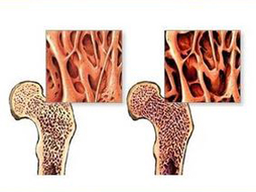 骨质疏松症：口服双膦酸盐依从性差的成本与结局