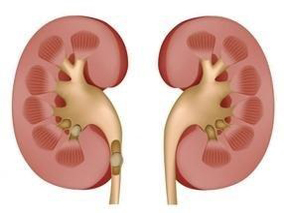 非透析依赖CKD患者使用ACEIs/ARBs与存活改善相关