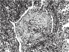 男1岁7个月,因咳嗽、气喘2个多月入院