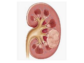 舒尼替尼或索拉非尼辅助治疗非转移性肾细胞癌是否有效？