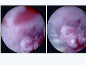 男47岁，因间断性全程肉眼血尿3月余入院