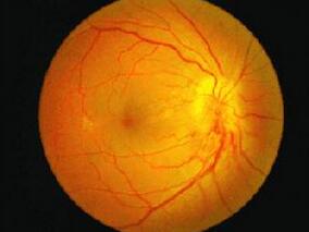 ACEI vs ARB治疗糖尿病视网膜病变的有效性