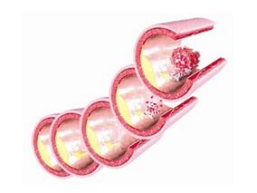 高强度他汀治疗与低密度脂蛋白降低幅度的关系