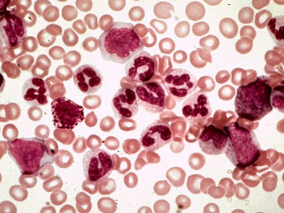 慢性粒细胞白血病慢性期的获益和风险：尼洛替尼vs伊马替尼