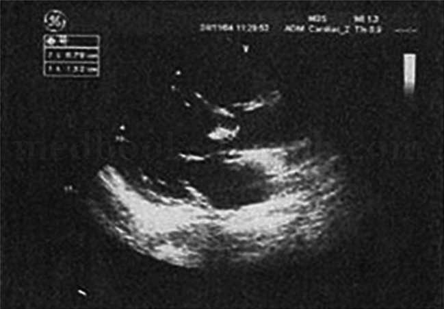 男53岁,因间断发热伴体重下降2个月就诊