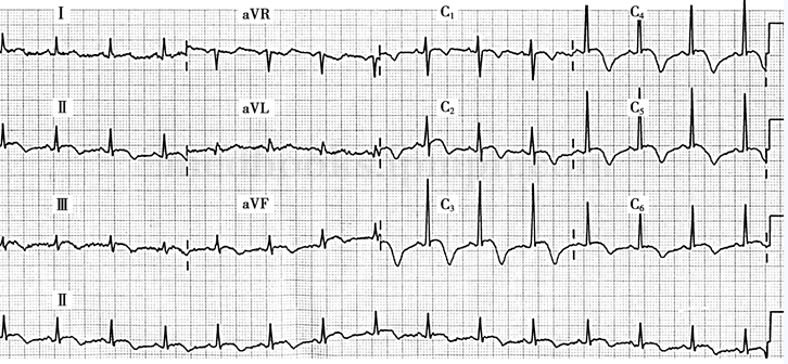 女40岁,因3天前头外伤后心悸、胸闷、恶心就诊