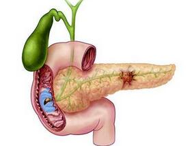 男57岁，主因左下腹痛3个月余、腹泻伴腰背痛2个月余入院