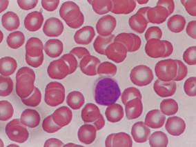 肺炎限制了idelalisib和entospletinib用于复发难治性CLL和NHL