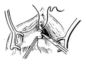 局限性前列腺癌患者：血清维生素D与不良病理过程的关系