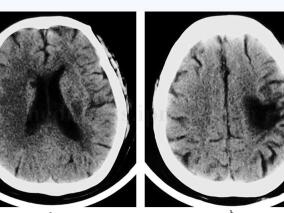 女72岁,因发作性双眼向右侧凝视12天,左侧肢体抽动1周入院