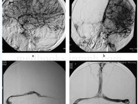 女20岁,因头痛呕吐9天,意识障碍5天以静脉窦血栓形成收入N‐ICU