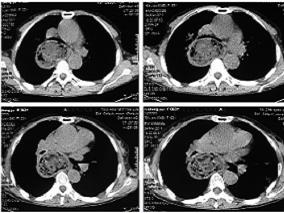 女63岁,因咳嗽、喘息11天入院