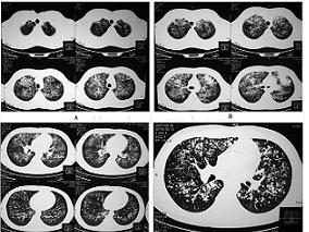 男28岁,因反复咳嗽、咳痰伴胸痛1个月余入院