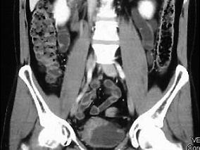 男46岁，因间歇性无痛性肉眼血尿5个月入院