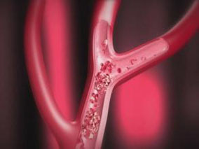 围绝经期或绝经后女性使用激素治疗的VTE风险