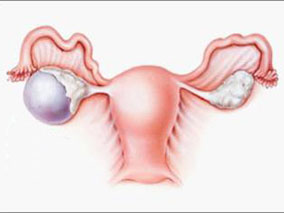 奥利司他可显著降低PCOS女性的BMI/体重