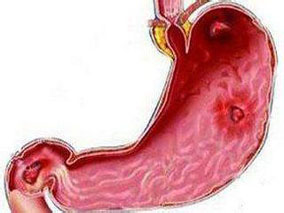 多学科讨论:PPI治疗重症患者压力性胃溃疡的有效性和安全性