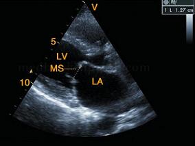 女42岁,主因呼吸困难、咳嗽、咯血就诊