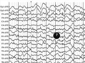 女66岁,因发作性精神恍惚,胡言乱语,双上肢摸索6个月,加重半个月就诊