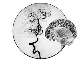 依达拉奉降低成年烟雾病患者过度灌注相关的神经功能缺陷