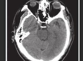 男45岁,因左侧肢体乏力1天就诊