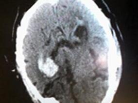 华法林联用低分子肝素钙致患者脑出血一例