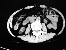 男33岁，因茶色尿19年，乏力6年余，关节肿大4年余入院