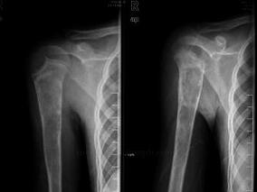 男14岁，右上臂隐痛2年，加重1周伴功能障碍1小时