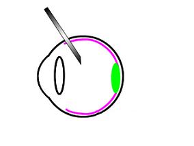 玻璃体腔注射贝伐单抗后复发性早产儿视网膜病变的临床管理